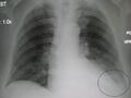 Lower lobe pneumonia with pleural effusion