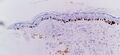 SOX10 immunohistochemistry of lentigo maligna