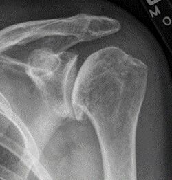 X-ray of osteoarthritis of the shoulder
