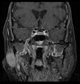Coronal MRI showing right parotid adenoid cystic carcinoma with perineural spread.