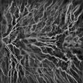 Laser Doppler imaging of retinal and choroidal blood flow