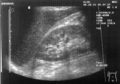 Morison's pouch on ultrasound