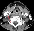CT scan of 70% blocked right carotid artery