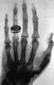 X-ray of Kölliker's hand by Wilhelm Röntgen