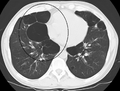 CT scan showing bullous emphysema