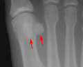 Sesamoid bones of the foot