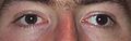 Strabismus