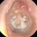 Myringotomy