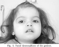 A girl with Jacobsen Syndrome