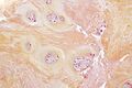 Degenerative disc disease