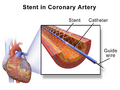 Illustration of angioplasty with stent