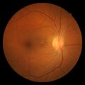 Hypertensive retinopathy
