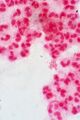 Neisseria gonorrhoeae with pus cells