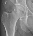 X-ray of subtle compressive hip fracture, labeled